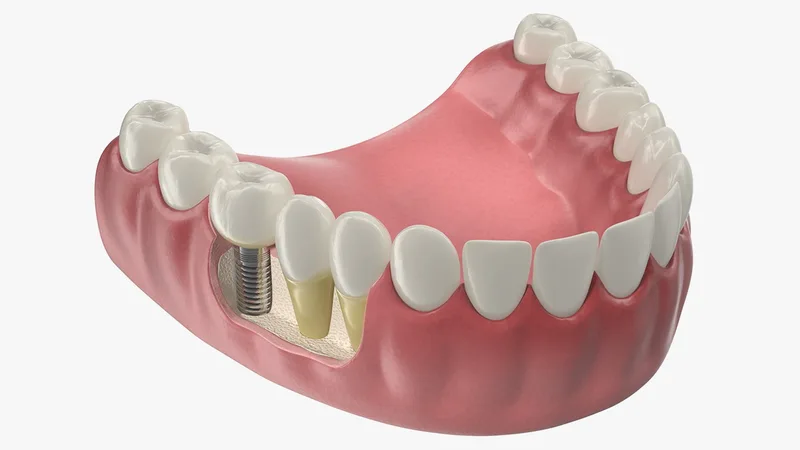 Lower Teeth Medical Model With Dental Implant 3D model preview