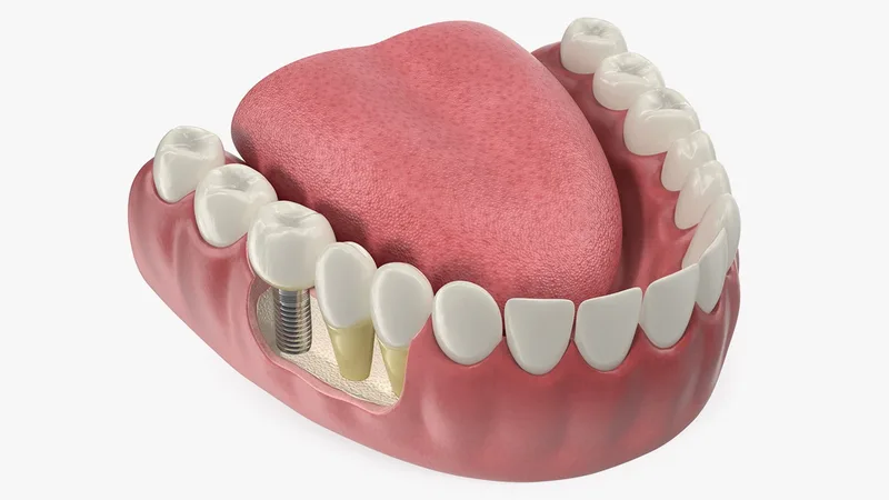 Teeth Tongue Medical Model With Dental Implant 3D model preview