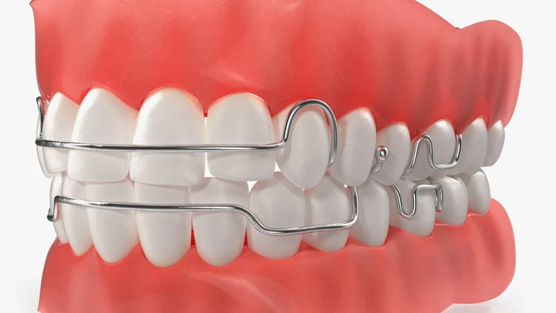 Typodont Tooth Orthodontic Retainer 3D model preview